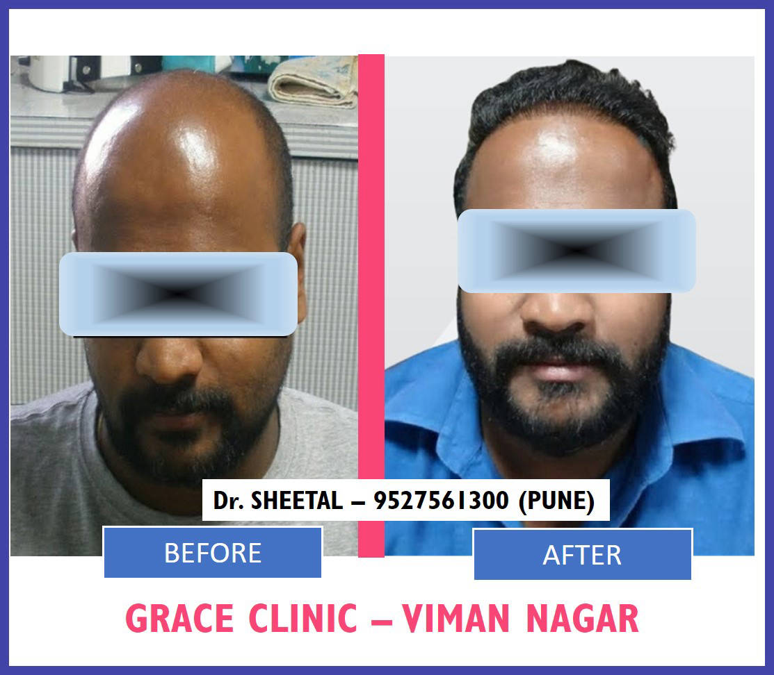 GRACE-HAIR-TRANSPLANT-BEFORE-AFTER