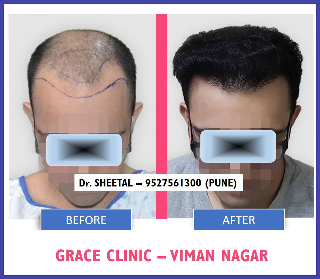 GRACE-HAIR-TRANSPLANT-BEFORE-AFTER
